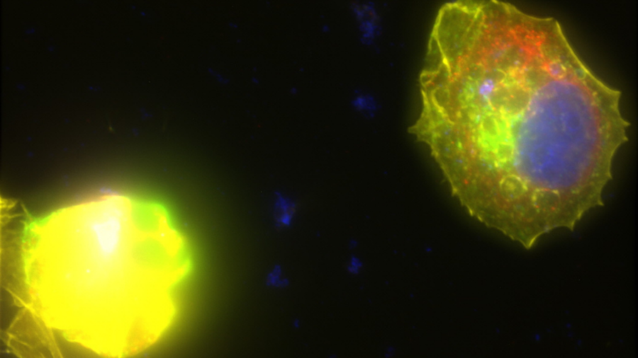 This image shows immunofluorescence of breast cancer cells treated with a MicroQuin therapeutic. Staining shows a normal nucleus (blue) and the therapeutic (green) localized to the cellâs endoplasmic reticulum (red). The drug forces the cytoskeleton (yellow) to collapse, inducing cell death. Credits: Scott Robinson, MicroQuin.