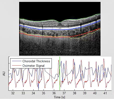 An optical coherence tomography scan of the eye showing choroidal thickness, with colored lines marking different layers. A graph below the image displays two signals over time: a blue line representing choroidal thickness and a red line representing the oximeter signal.