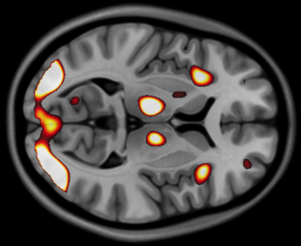 An MRI scan of a human brain shows brightly colored spots that indicate brain activity during spatial orientation tasks. The active regions are highlighted in shades of yellow, orange, and red to represent varying intensity. A large highlight covers the back of the brain, and there are smaller spots in the middle of the brain and towards the front. These regions correspond to specific areas of the brain that engage in spatial processing.